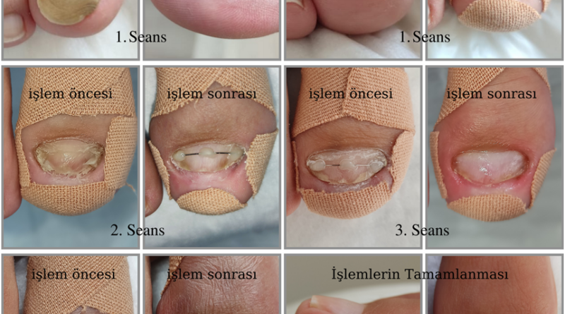 Onikogrifoz gibi ileri tırnak deformasyonlardında Podolojik tedavi uygulamaları