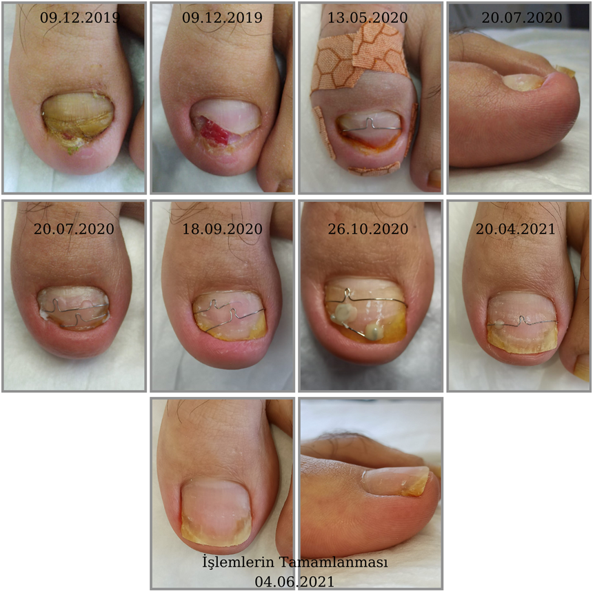Hipertrofik Kalınlaşmış Tırnakta Podolojik tedavi  uygulamaları süreci. Tırnak ünitesinde ayrıca hiponişyumda hipertrofi mevcuttur.